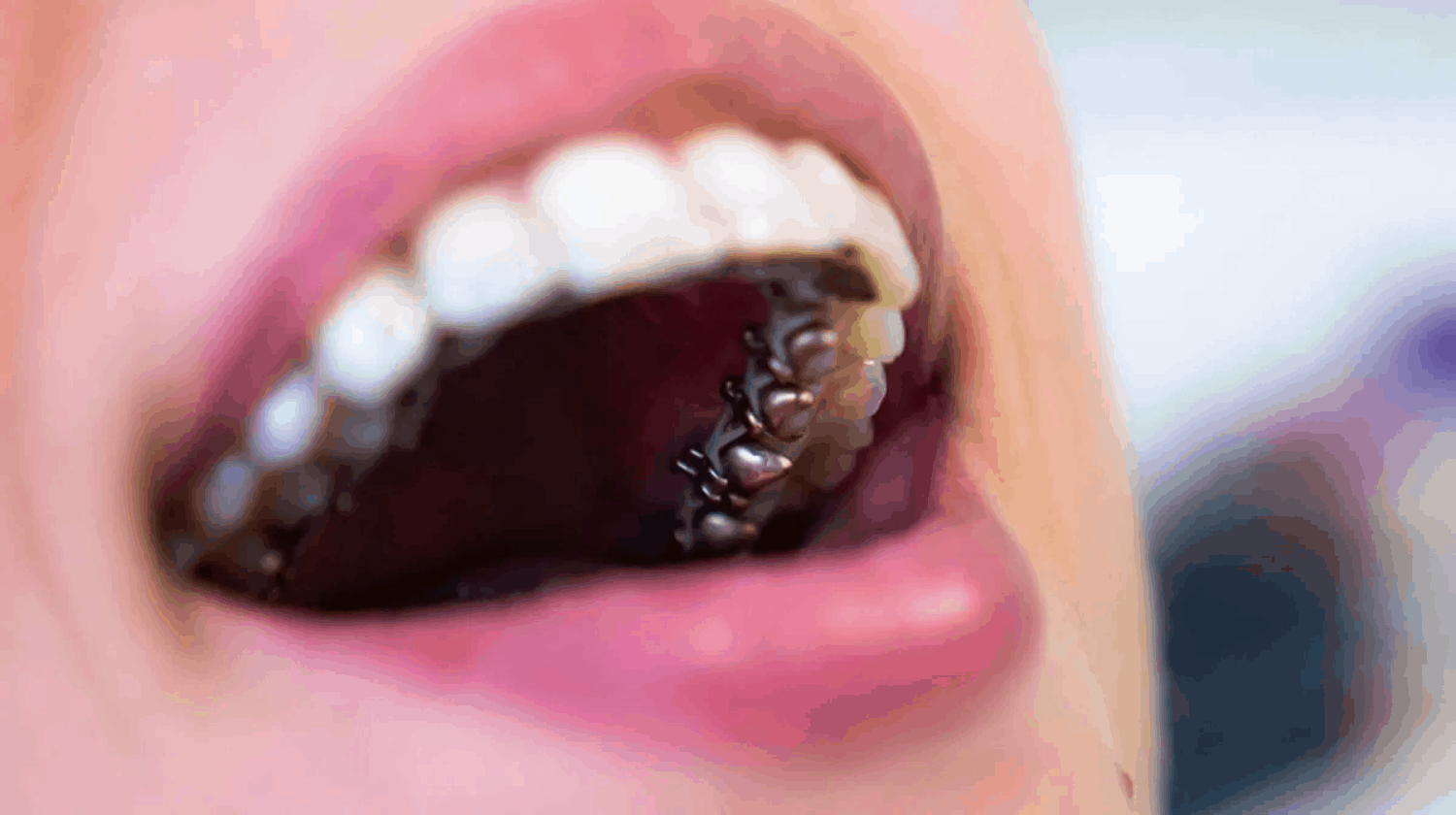 Lingual Braces