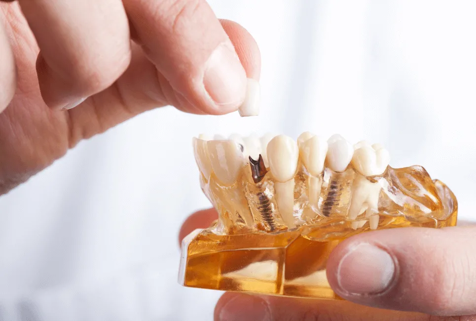 Guide to Dental Implants: Everything You Need to Know