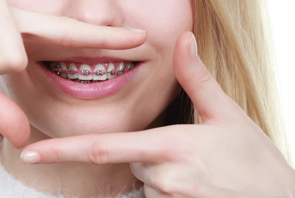 Guide to Finding the Best Aligners and Braces