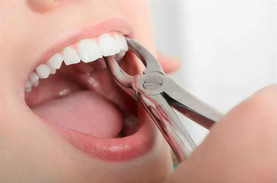 Teeth Extraction