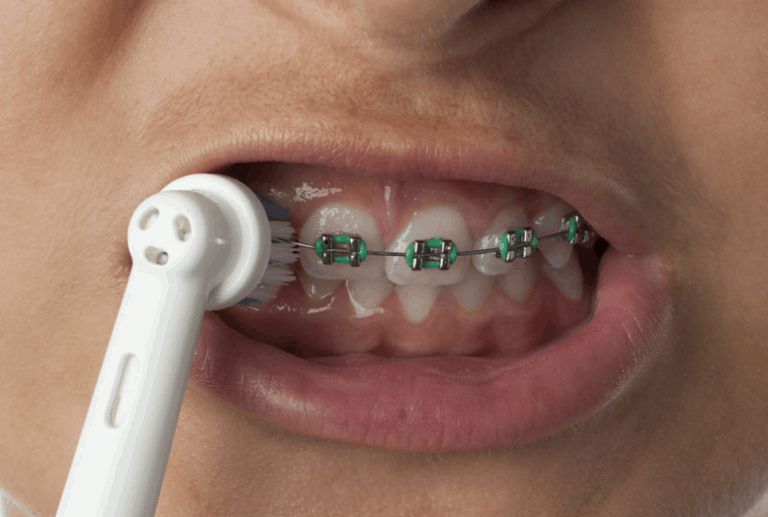 How to Find the Best Electric Toothbrush for Braces Dentalisty