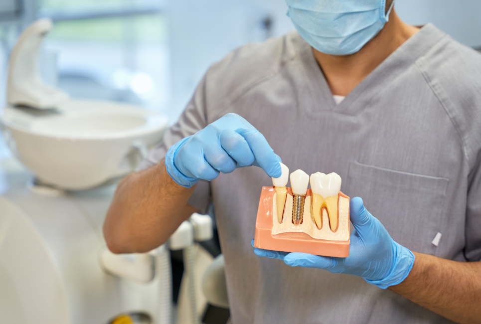 Who Makes the Best Dental Implants? My Top Five Clear Choice